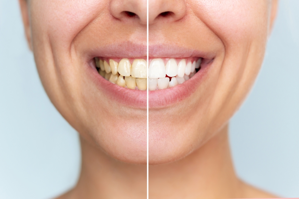teeth whitening Ponte Vedra